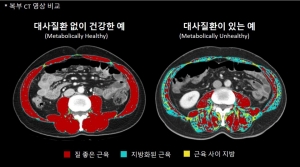 질좋은 근육과 대사질환 위험 연관성 연구. 사진=서울아산병원 제공