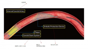경동맥 스텐트 삽입술